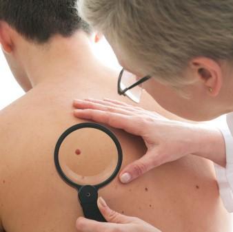 Skin Cancer