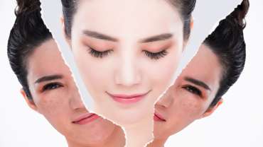 CHEMICAL PEELS